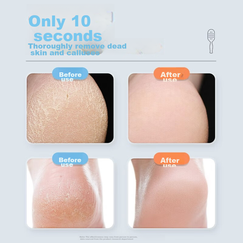 Xiaotianlai Foot Scrubber, Foot File, Foot Care Tool, Dead Skin Remover, Callus...